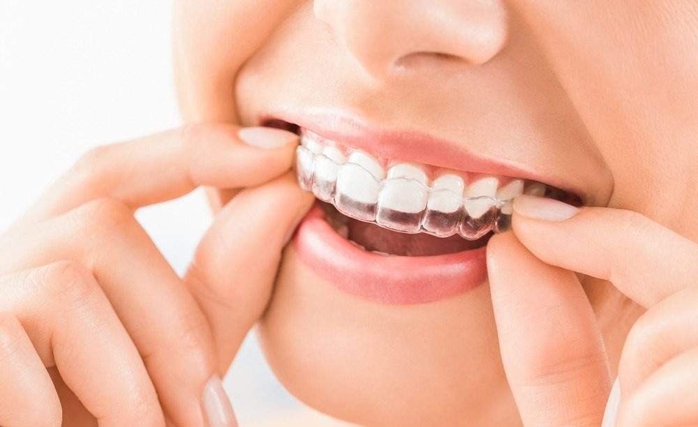 Transparent Braces and Invisalign